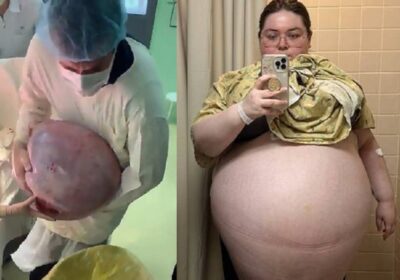 “A sensação era de estar grávida de dez filhos” diz mulher que removeu tumor de 47 kg