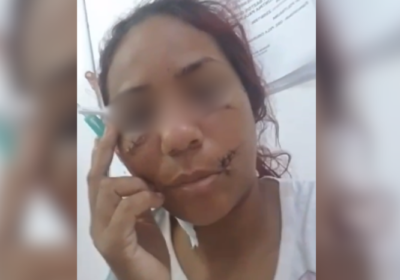 VÍDEOS: Mulher que levou 17 facadas mostra rosto após ataque de ex no AM