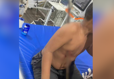 VÍDEO: Após brincar em obra, menino fica com vergalhão atravessado no corpo